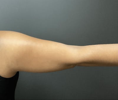 Arms Before & After Gallery - Patient 133191339 - Image 1