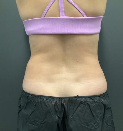 Flanks Before & After Gallery - Patient 133191350 - Image 2