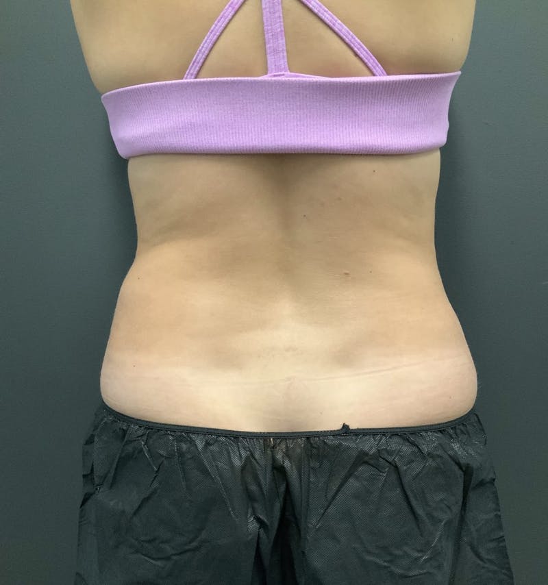 Flanks Before & After Gallery - Patient 133191350 - Image 2