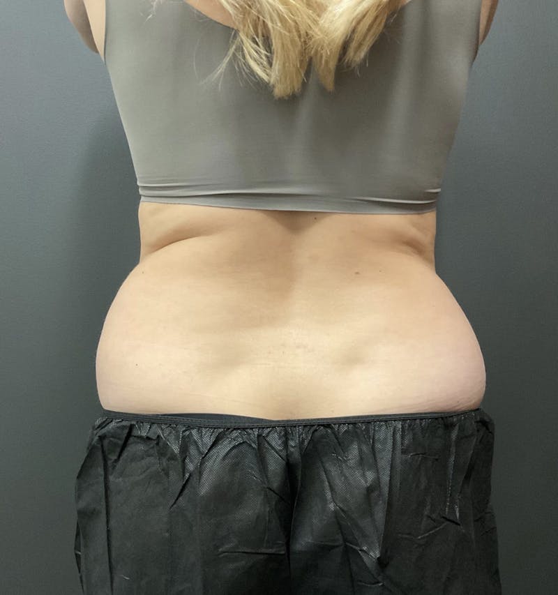 Flanks Before & After Gallery - Patient 133191350 - Image 1