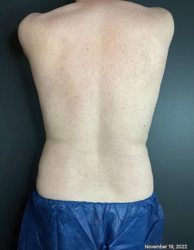 Flanks Before & After Gallery - Patient 133191351 - Image 2