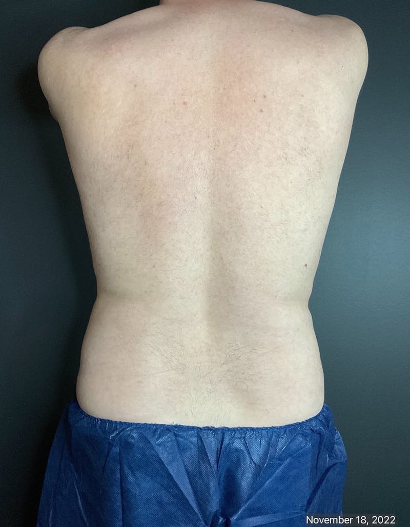 Flanks Before & After Gallery - Patient 133191351 - Image 2