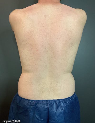 Flanks Before & After Gallery - Patient 133191351 - Image 1