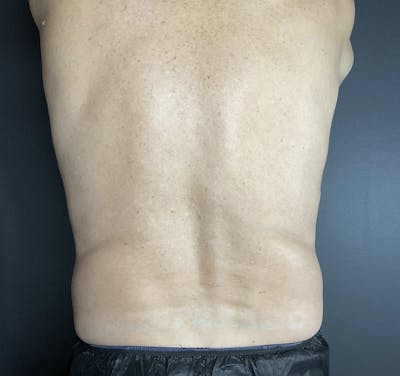 Flanks Before & After Gallery - Patient 133191352 - Image 2