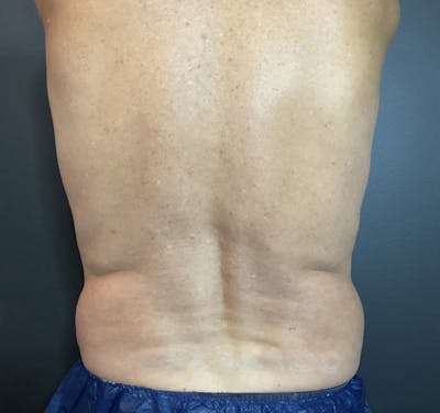 Flanks Before & After Gallery - Patient 133191352 - Image 1