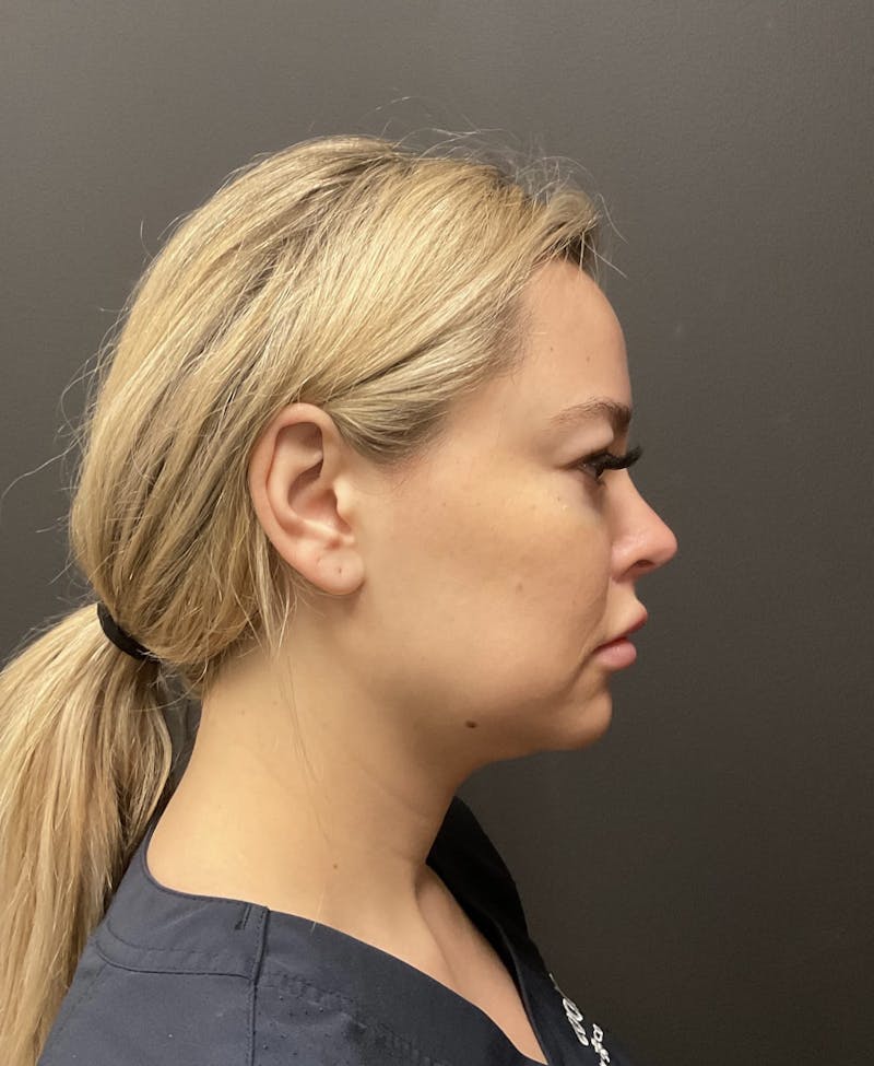 Double Chin Before & After Gallery - Patient 133191357 - Image 1