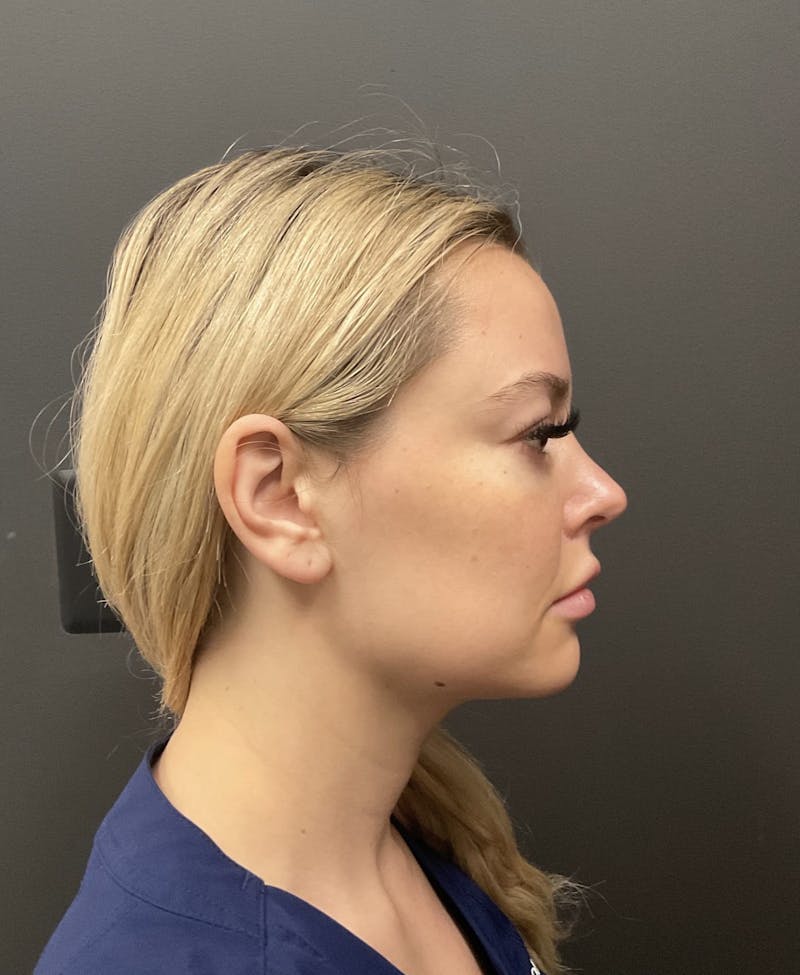 Double Chin Before & After Gallery - Patient 133191357 - Image 2
