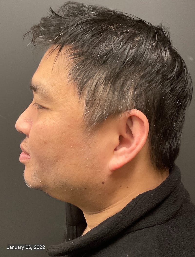 Double Chin Before & After Gallery - Patient 133191358 - Image 1
