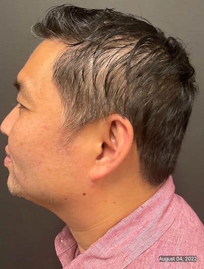 Double Chin Before & After Gallery - Patient 133191358 - Image 2