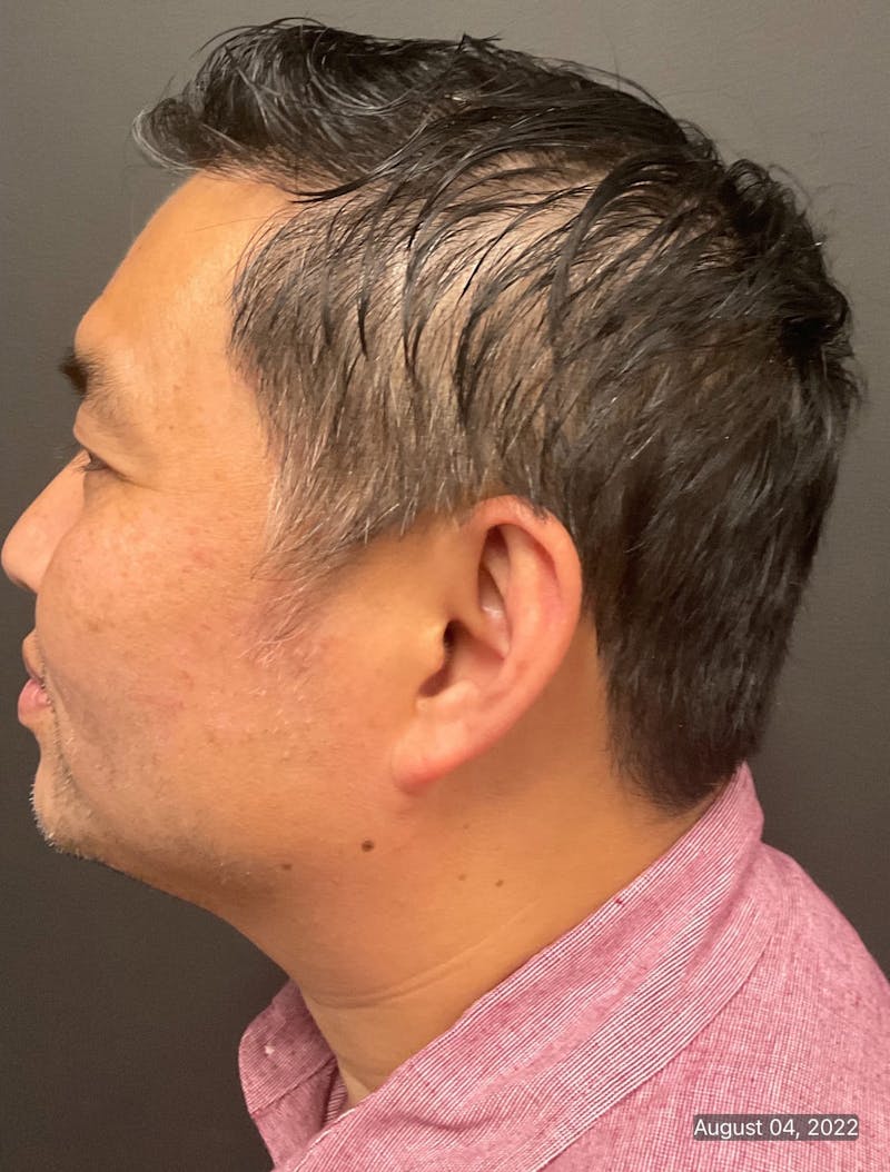 Double Chin Before & After Gallery - Patient 133191358 - Image 2
