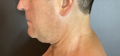 Double Chin Before & After Gallery - Patient 133191359 - Image 1