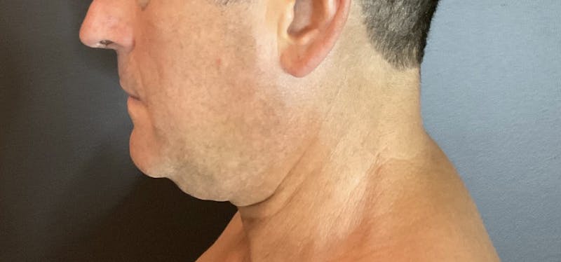 Double Chin Before & After Gallery - Patient 133191359 - Image 1