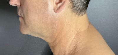 Double Chin Before & After Gallery - Patient 133191359 - Image 2
