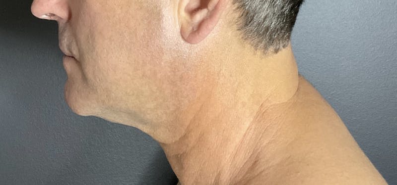 Double Chin Before & After Gallery - Patient 133191359 - Image 2
