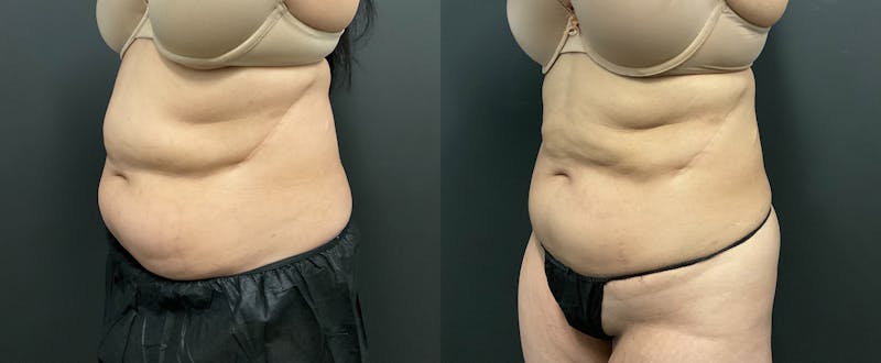 Abdomen Before & After Gallery - Patient 133226390 - Image 1