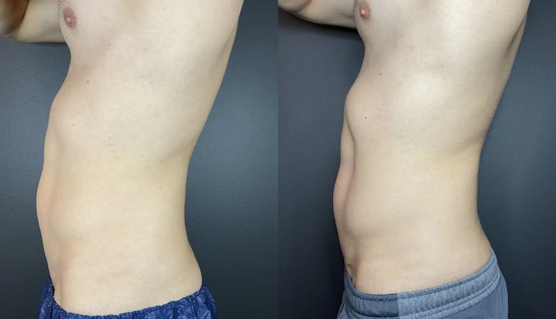 Abdomen Before & After Gallery - Patient 133226391 - Image 1