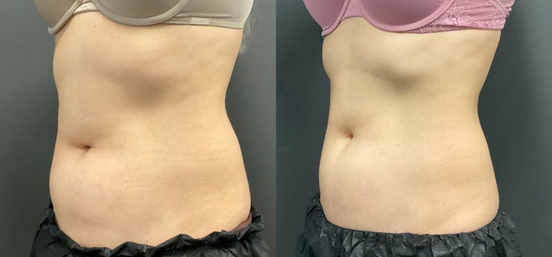 Abdomen Before & After Gallery - Patient 133226389 - Image 1