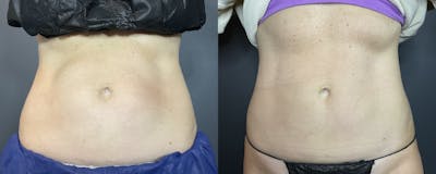 Abdomen Before & After Gallery - Patient 133226388 - Image 1