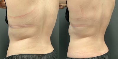 Upper & Lower Back Before & After Gallery - Patient 133226401 - Image 1