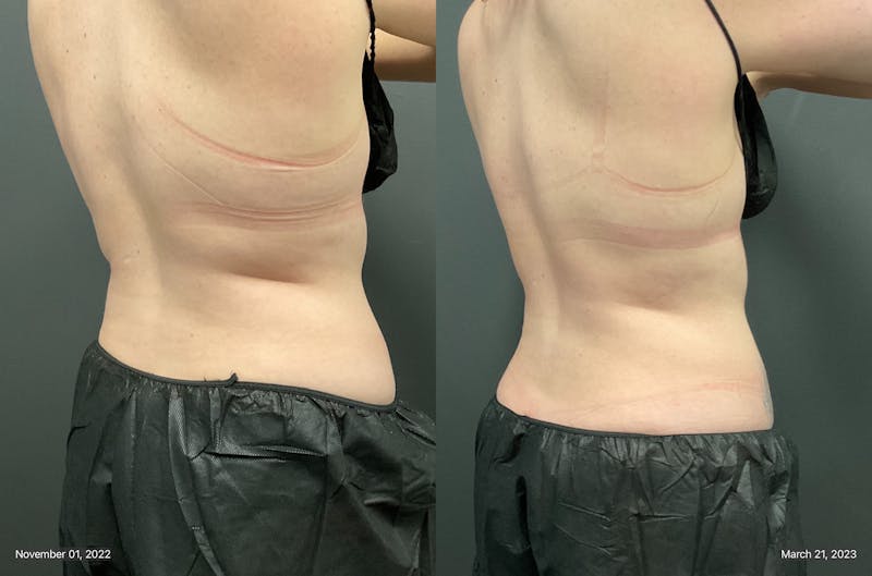 Upper & Lower Back Before & After Gallery - Patient 133226400 - Image 1