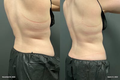 Upper & Lower Back Before & After Gallery - Patient 133226400 - Image 1