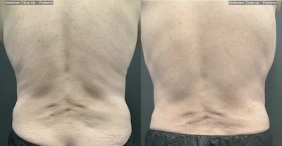 Upper & Lower Back Before & After Gallery - Patient 133226399 - Image 1