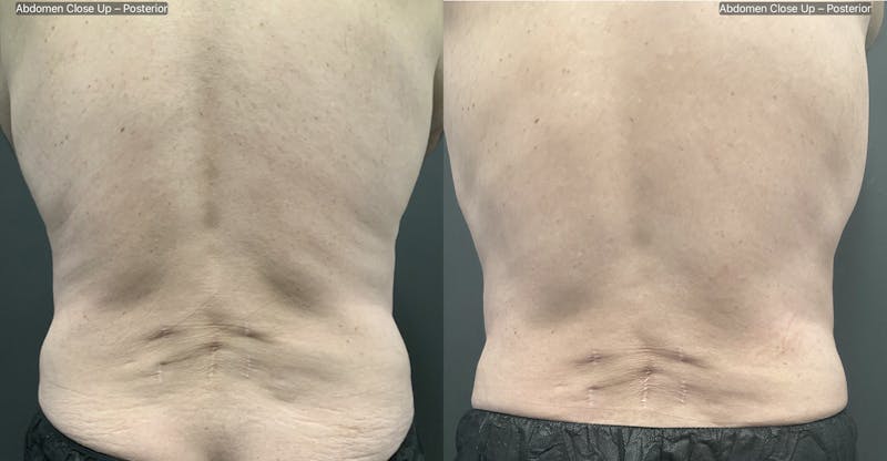 Upper & Lower Back Before & After Gallery - Patient 133226399 - Image 1