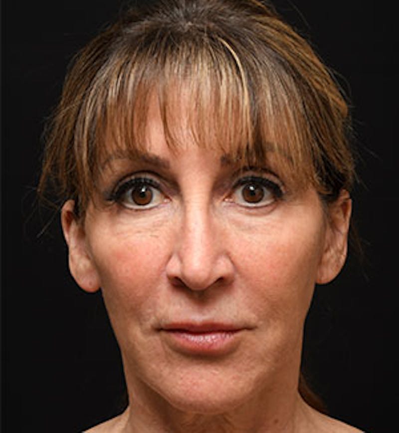 Facelift Before & After Gallery - Patient 97583461 - Image 1