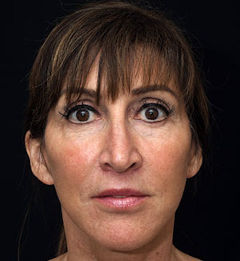 Facelift Before & After Gallery - Patient 97583461 - Image 2