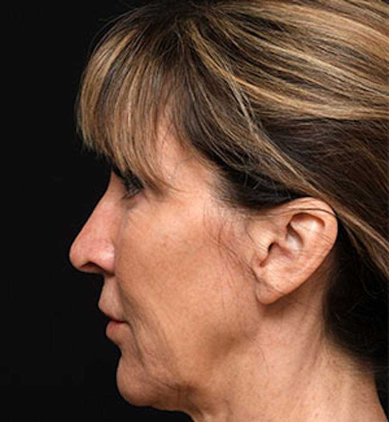 Facelift Before & After Gallery - Patient 97583461 - Image 3