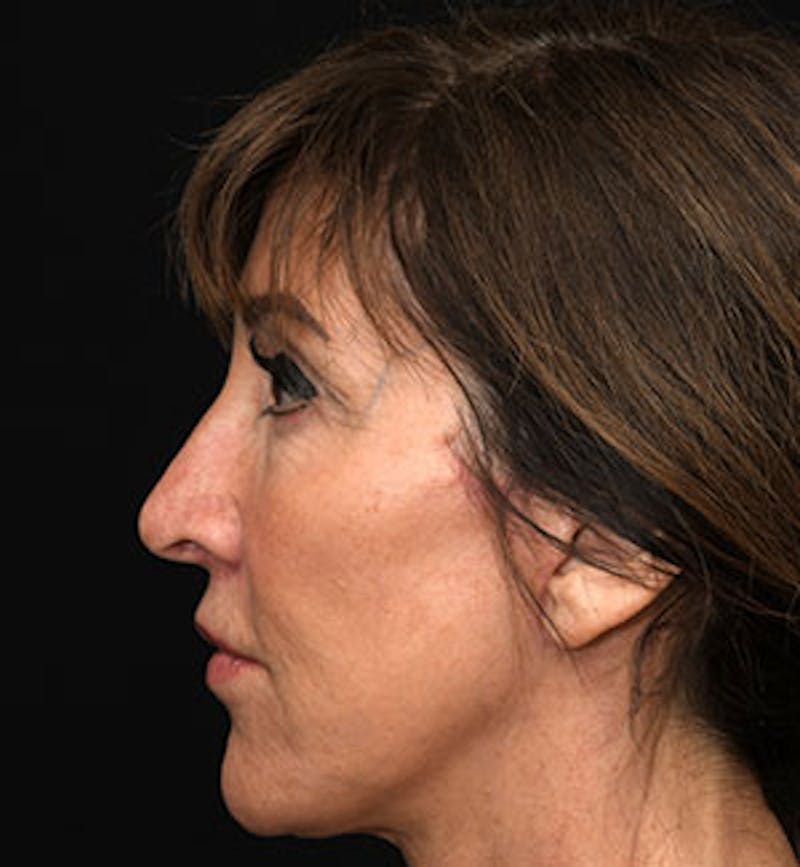 Facelift Before & After Gallery - Patient 97583461 - Image 4