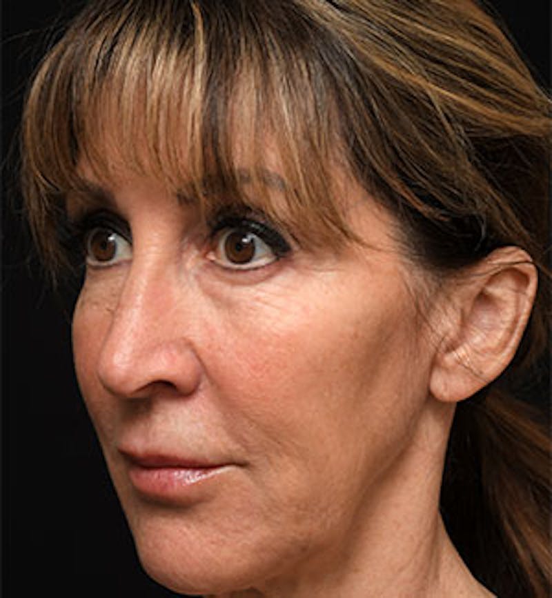 Facelift Before & After Gallery - Patient 97583461 - Image 5