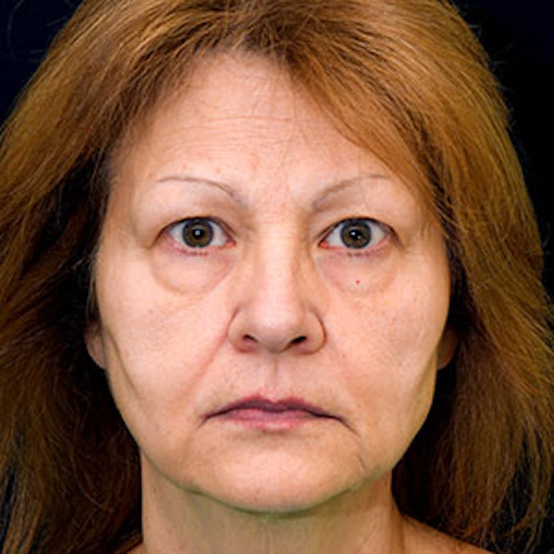 Facelift Before & After Gallery - Patient 97583466 - Image 1