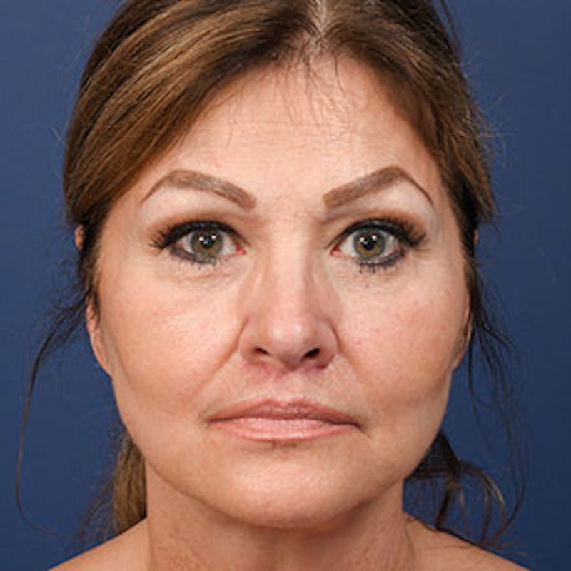 Facelift Before & After Gallery - Patient 97583466 - Image 2