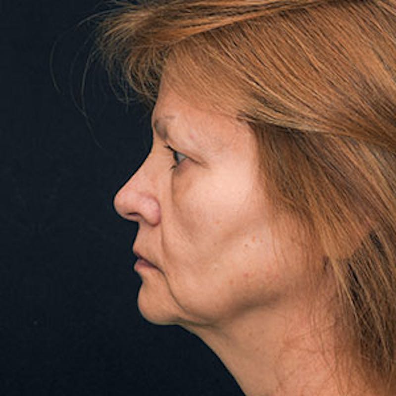 Facelift Before & After Gallery - Patient 97583466 - Image 3