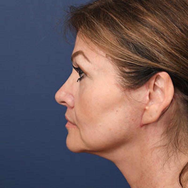 Facelift Before & After Gallery - Patient 97583466 - Image 4