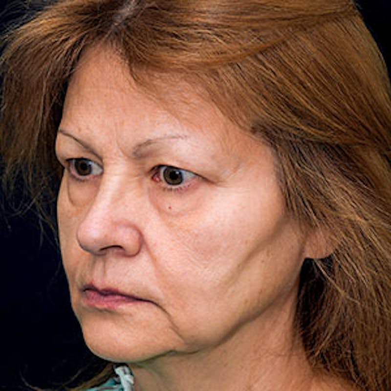 Facelift Before & After Gallery - Patient 97583466 - Image 5