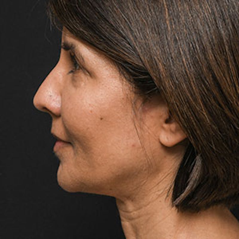 Facelift Before & After Gallery - Patient 97583477 - Image 3