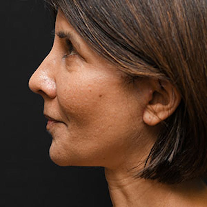 Facelift Before & After Gallery - Patient 97583477 - Image 4