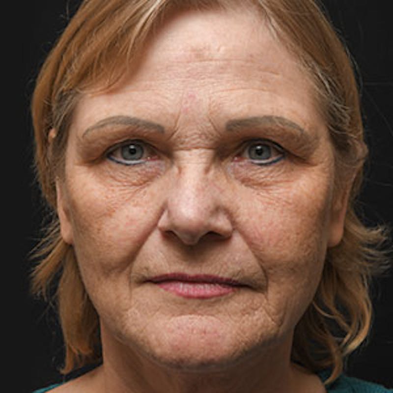 Facelift Before & After Gallery - Patient 97583479 - Image 1