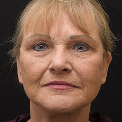 Facelift Before & After Gallery - Patient 97583479 - Image 2
