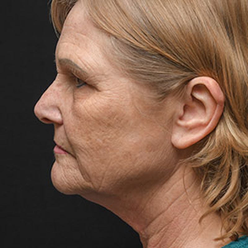Facelift Before & After Gallery - Patient 97583479 - Image 3