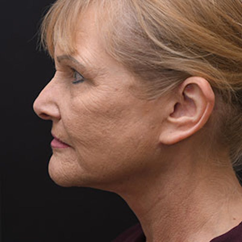 Facelift Before & After Gallery - Patient 97583479 - Image 4