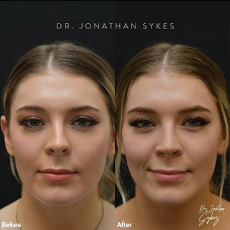 Rhinoplasty Before & After Gallery - Patient 97583628 - Image 1