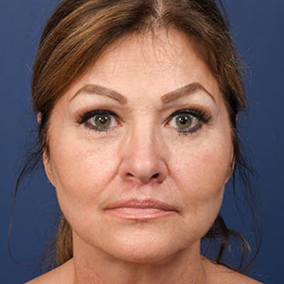 Blepharoplasty Before & After Gallery - Patient 97583643 - Image 2