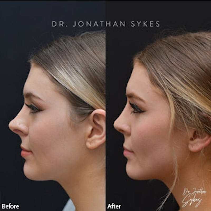 Rhinoplasty Before & After Gallery - Patient 97583628 - Image 2