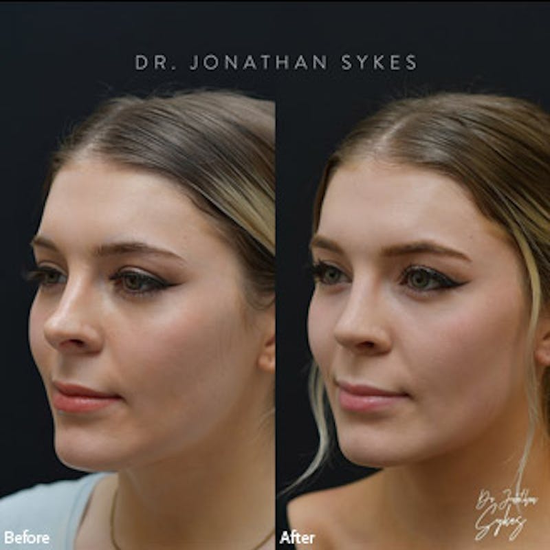 Rhinoplasty Before & After Gallery - Patient 97583628 - Image 3