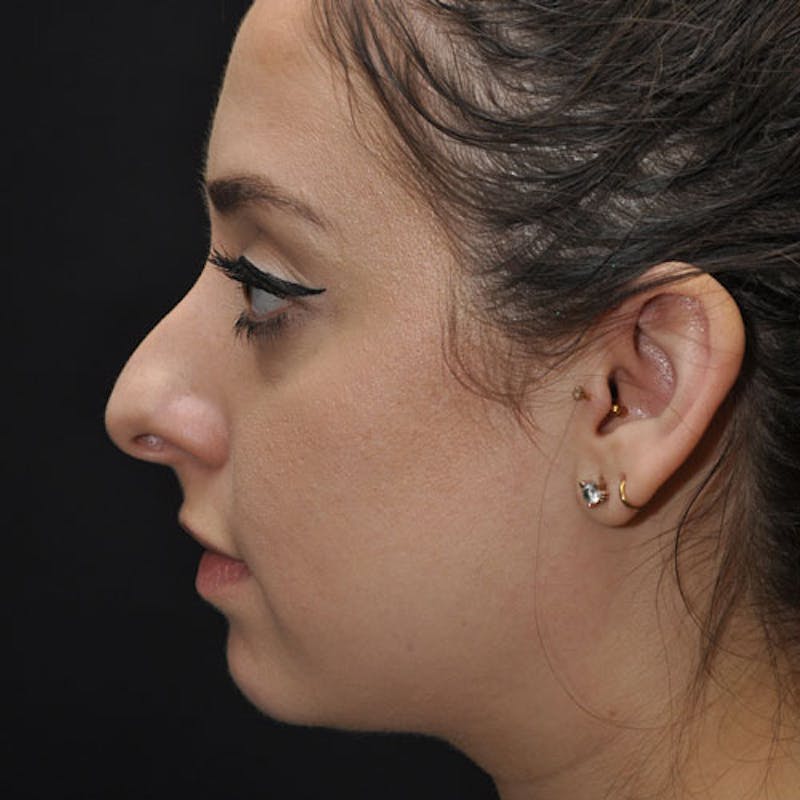 Chin Augmentation Before & After Gallery - Patient 97583666 - Image 1