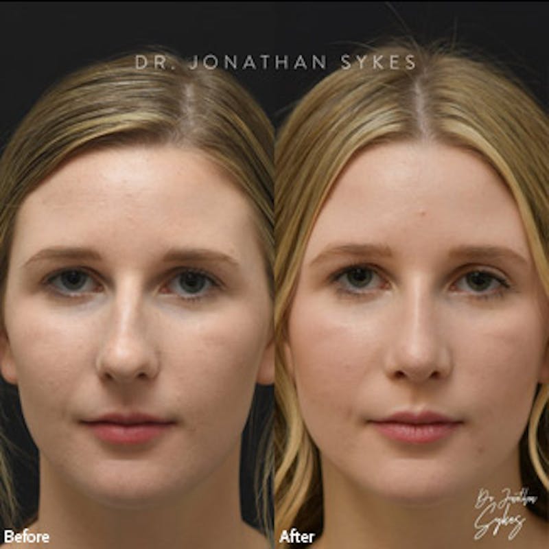 Rhinoplasty Before & After Gallery - Patient 97583645 - Image 1