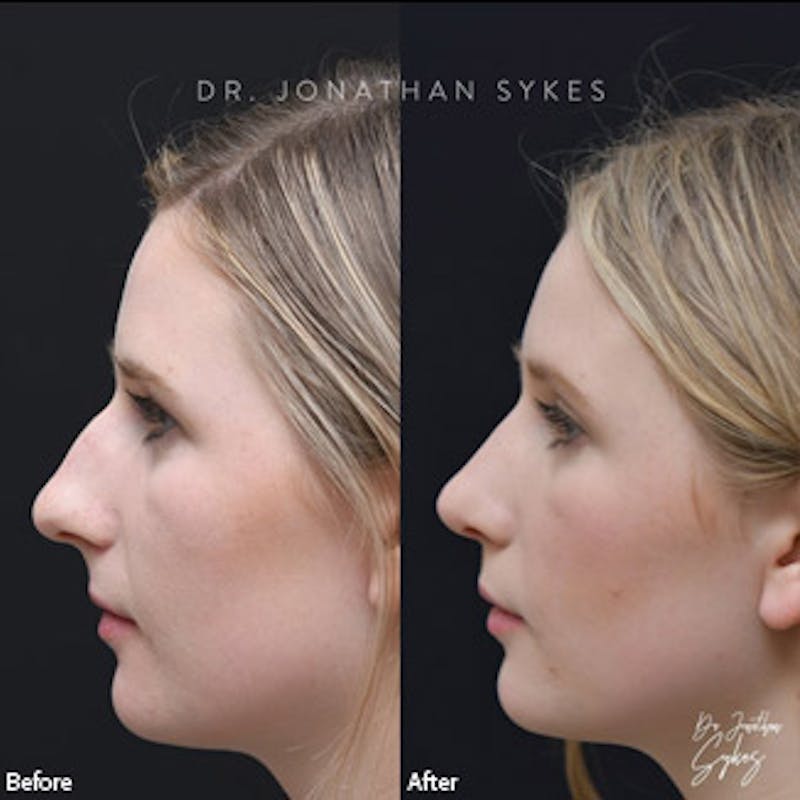 Rhinoplasty Before & After Gallery - Patient 97583645 - Image 2